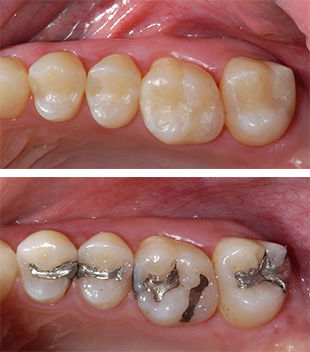 Silver Amalgam fillings next to Composite resin fillings