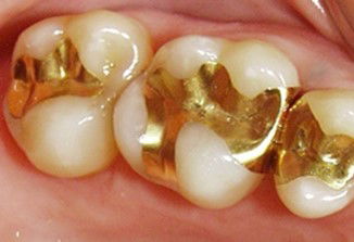 Gold fillings