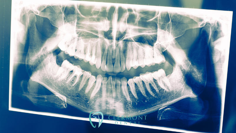 Dental xrays