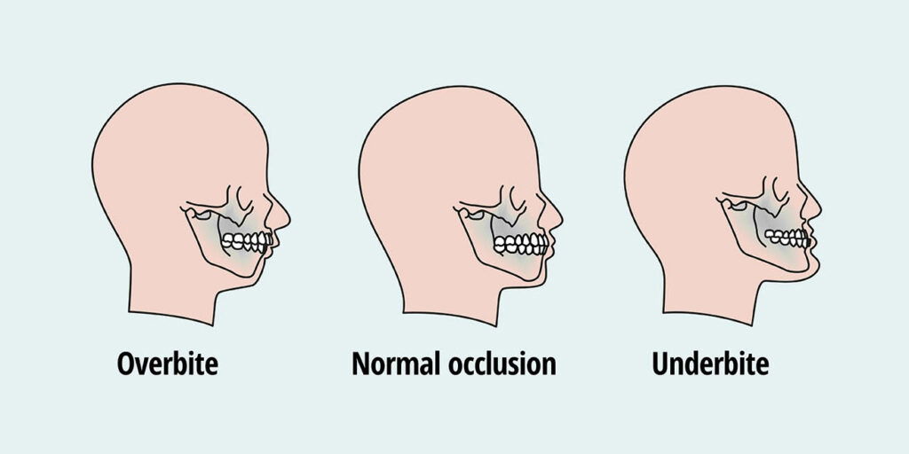 Image showing the difference between an overbite and underbite