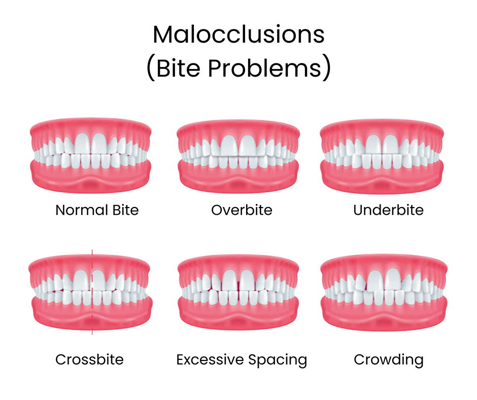 Image showing the different types of malocclusions